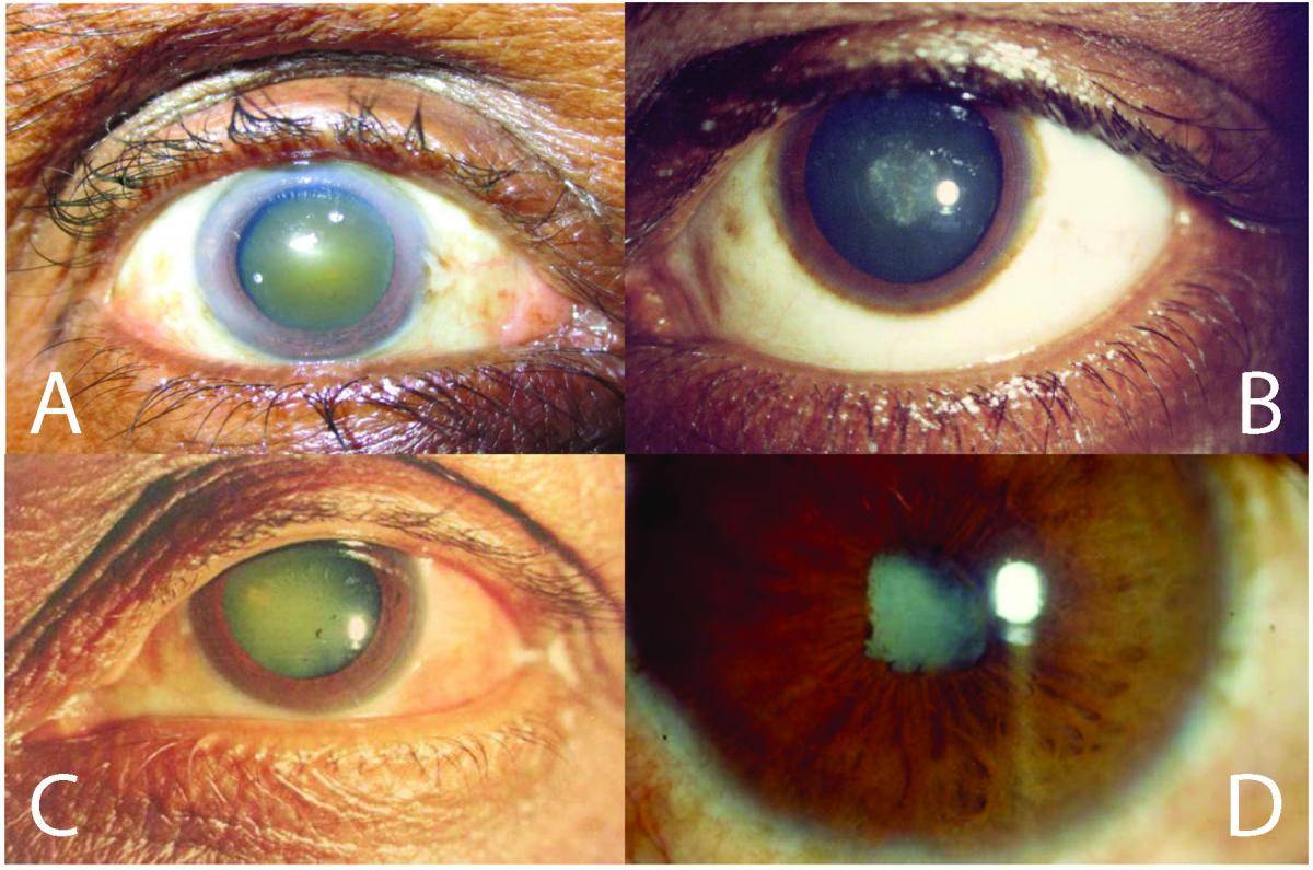 Кератопатия роговицы глаза