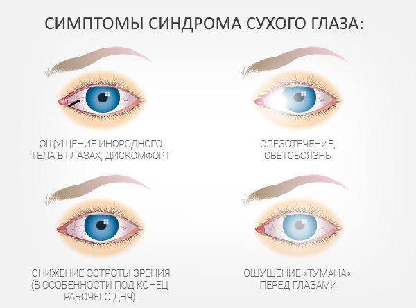 Синдром «сухого глаза»: симптомы и лечение, народные средства при синдроме сухого глаза