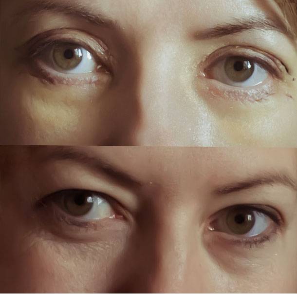 Синяки под глазами: причины у женщин, почему, от чего, крем