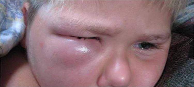 Как быстро снять отек глаз после аллергии