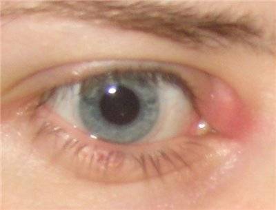 Болит уголок глаза внешний или внутренний
