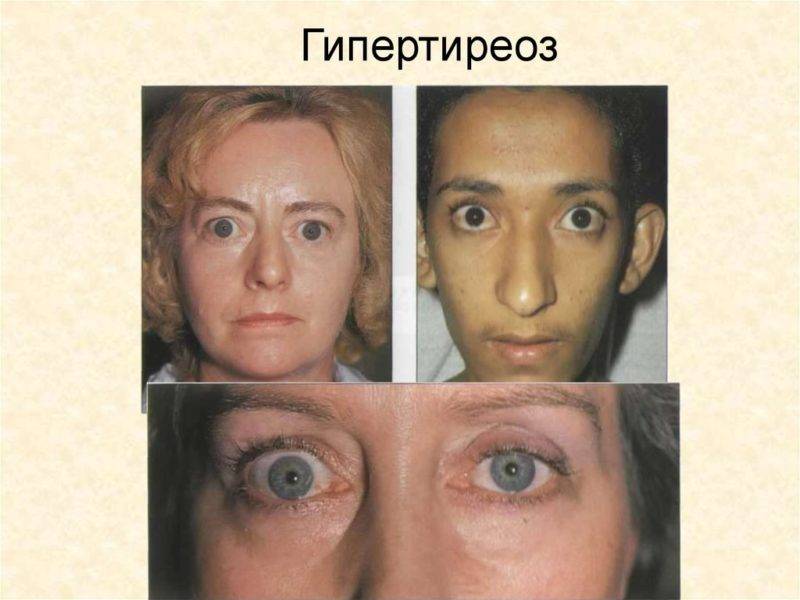 Что такое экзофтальм: причины, симптомы, лечение oculistic.ru
что такое экзофтальм: причины, симптомы, лечение