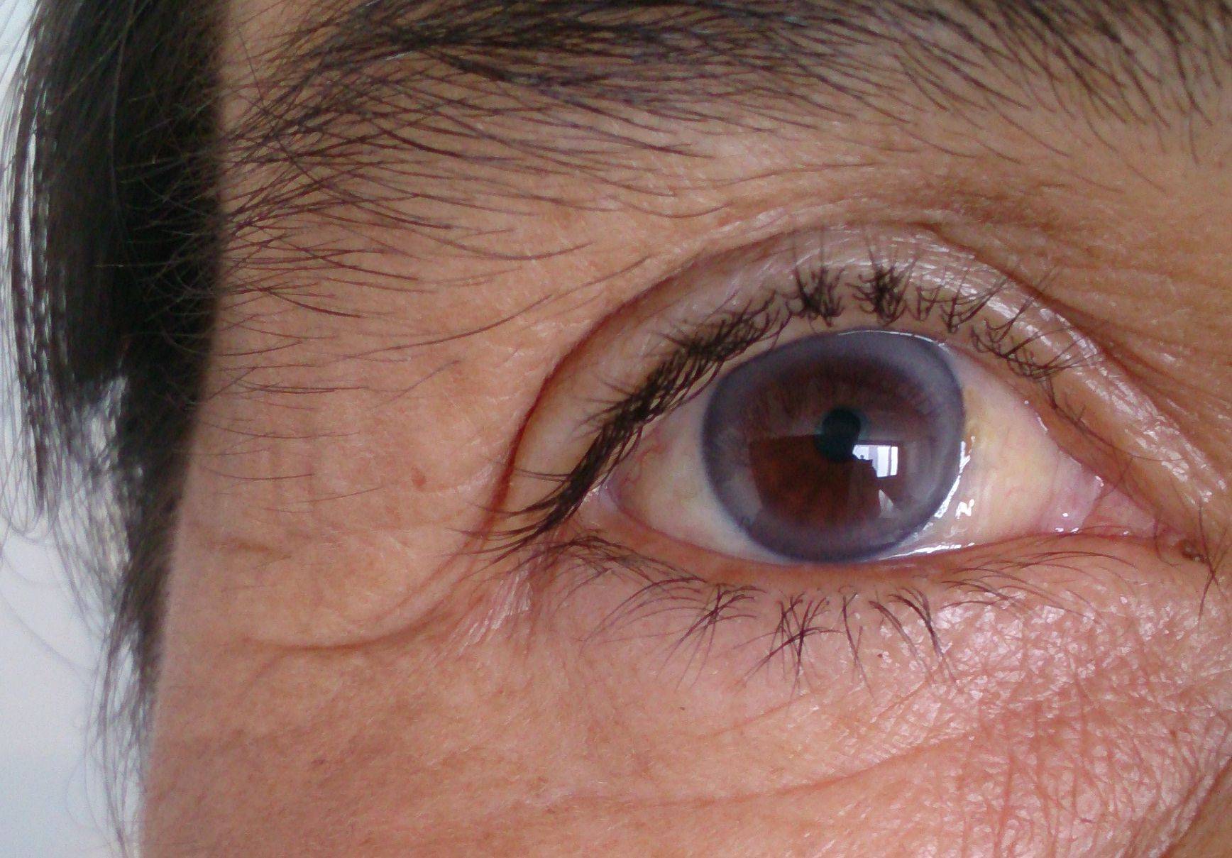 Заболевания роговицы глаза: симптомы, диагностика и лечение