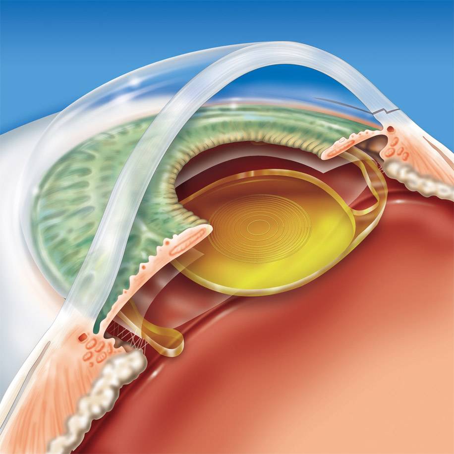 Факоэмульсификация катаракты и имплантацией иол — описание метода и операции по замене хрусталика, цены на искусственные хрусталики
