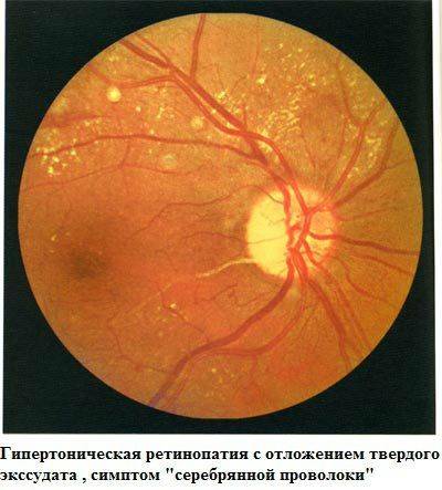 Что наверняка поможет глазам? средства лечения ретинопатии: от целебных трав до операции