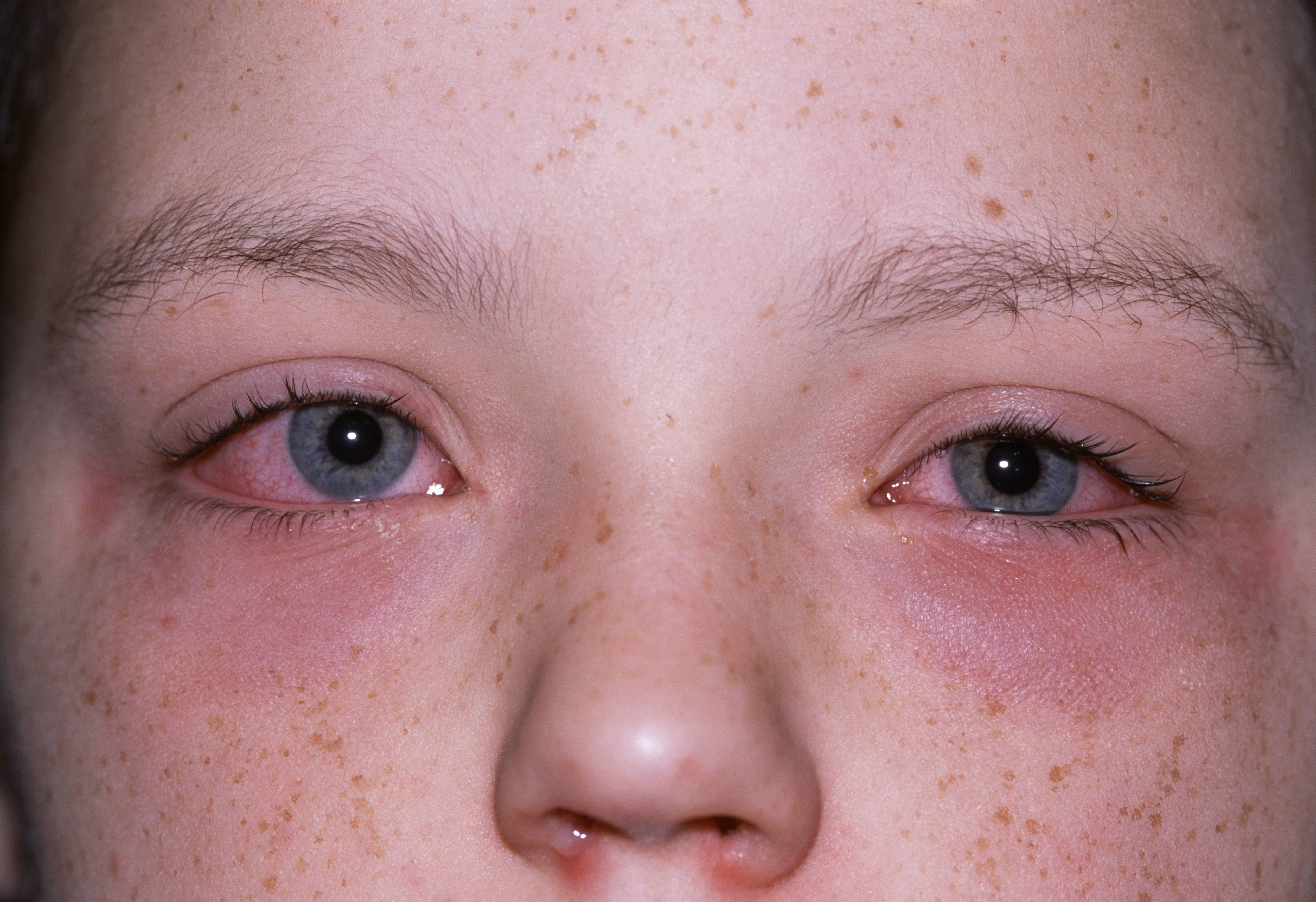 Аллергический конъюнктивит у ребенка: причины, симптомы, лечение