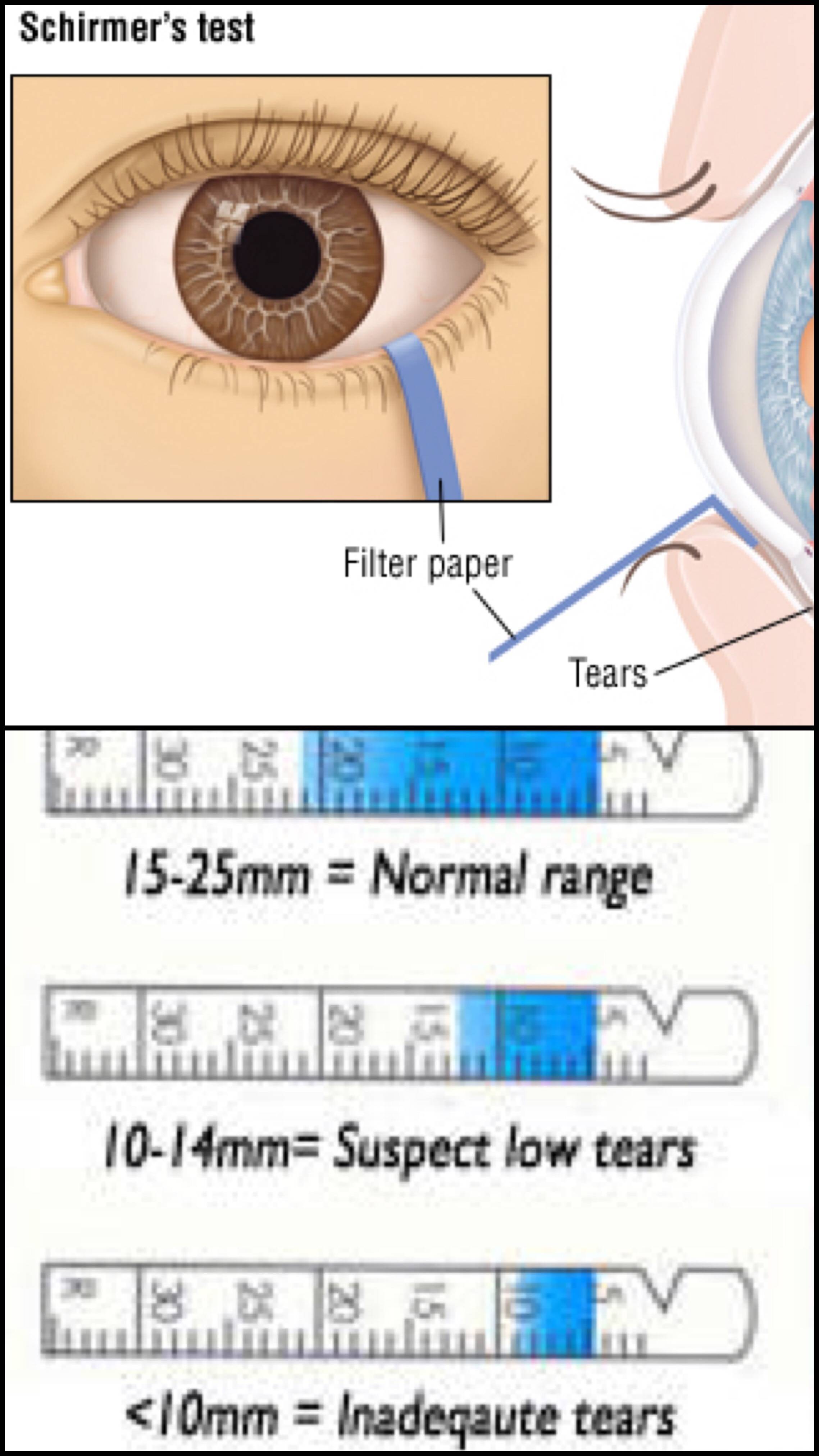 Тест (проба) ширмера: техника проведения - "здоровое око"
