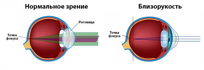 Операция на глаза при близорукости: стоимость, виды коррекции миопии (лазерная, замена хрусталика)