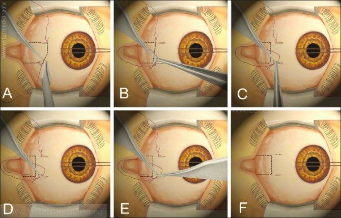 Эвисцерация глазного яблока: показания и противопоказания, ход операции, преимущества и недостатки