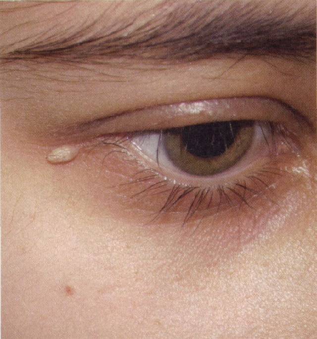 Причины появления кисты на глазу и способы лечения