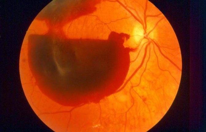 Деструкция стекловидного тела глаза: причины, симптомы и лечение
