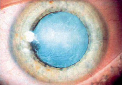 Факосклероз хрусталика глаза: причины и лечение