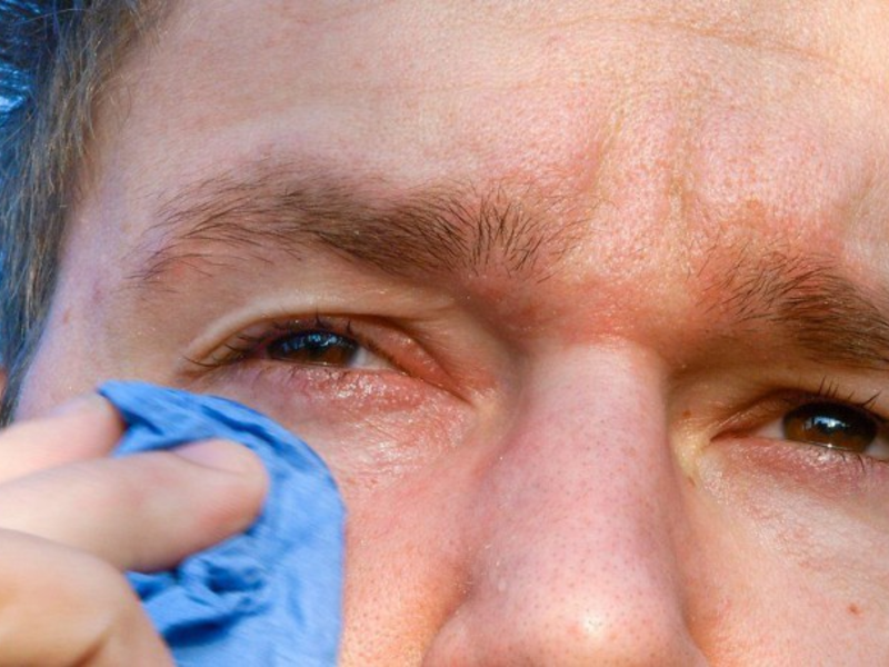 Причины появления аллергии на веках глаз