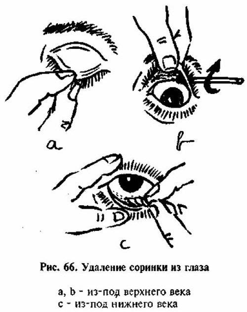 Как промыть глаз от соринки: проверенные способы и препараты - sammedic.ru