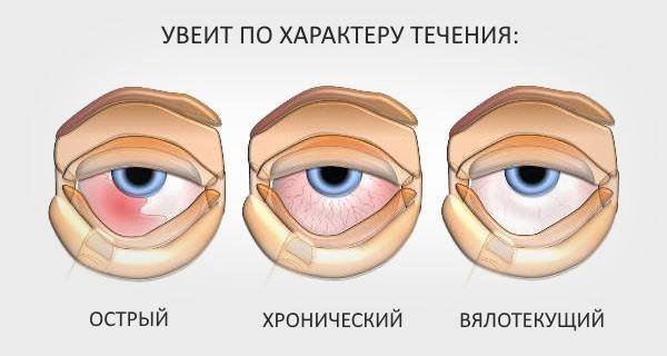 Заболевание глаз увеит: причины, симптомы и лечение