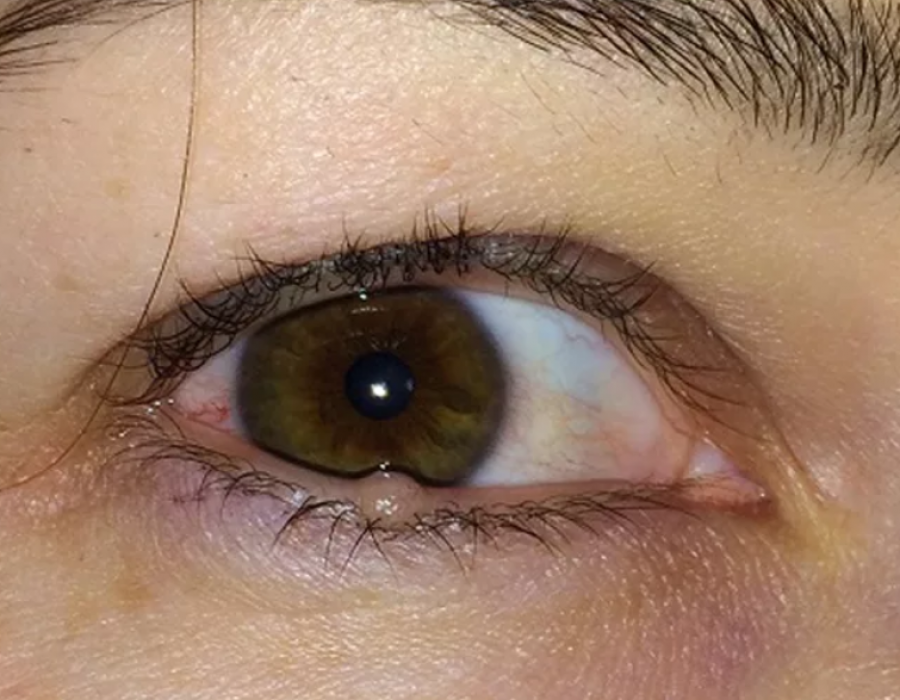 Киста на глазу: симптомы (фото), причины, что делать и как лечить у взрослого или ребенка, удаление, осложнения, профилактика