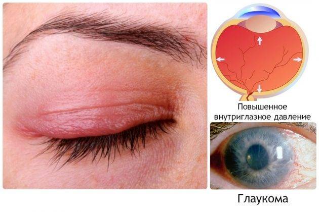 Острый приступ глаукомы: причины, симптомы, первая помощь