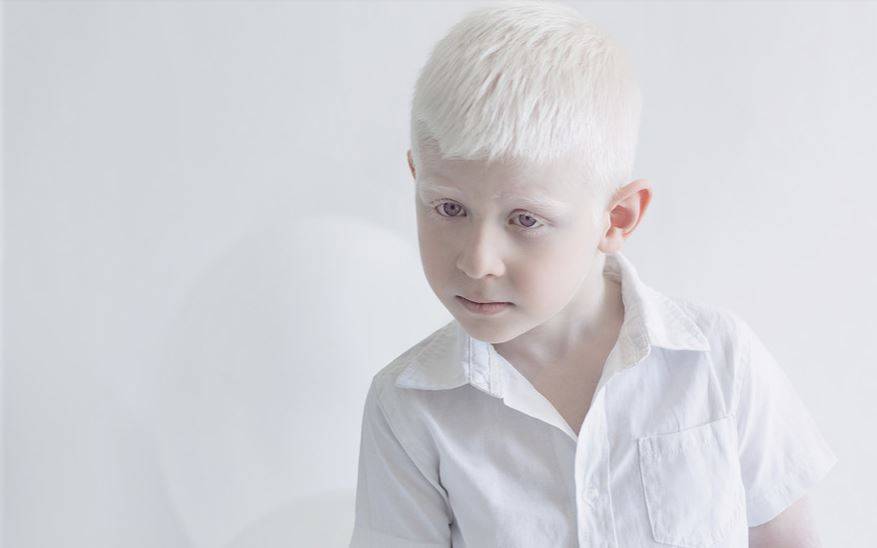 Глазокожный альбинизм: причины, симптомы, лечение
