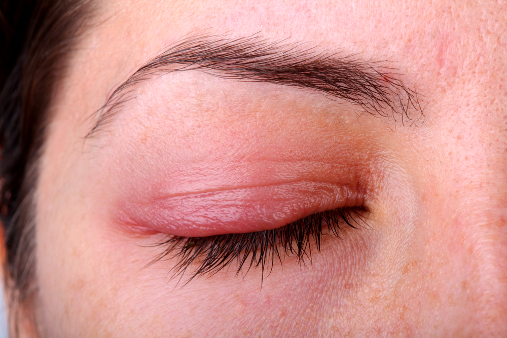 Шелушатся веки глаз: причины и симптомы - "здоровое око"