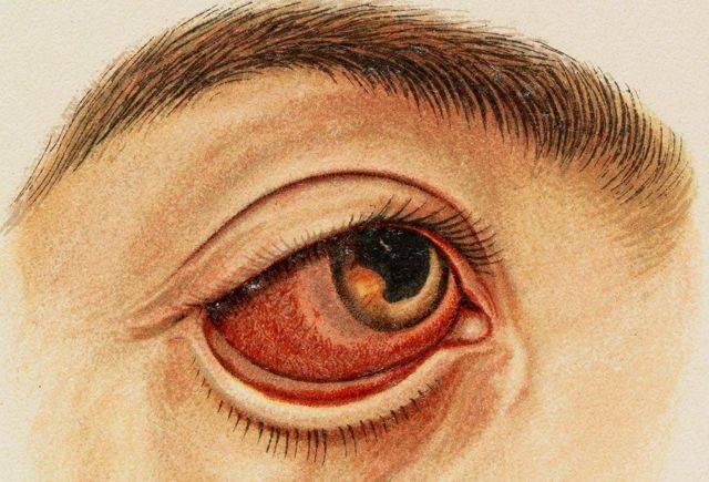 Воспаление радужной оболочки глаза: как называется по научному, причины, симптомы, лечение ирита