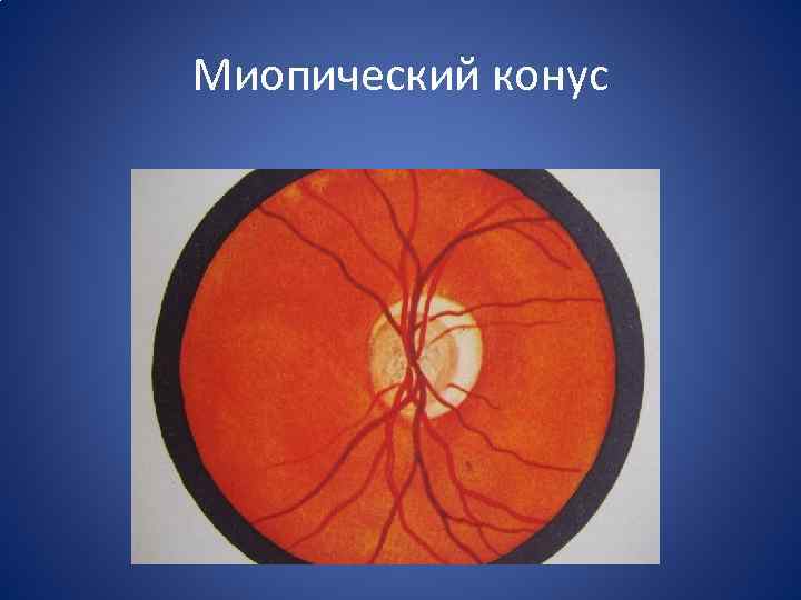 Миопическая стафилома. миопический конус и стафилома — причины и лечение. состояние
зрительного нерва и ретинальных сосудов
