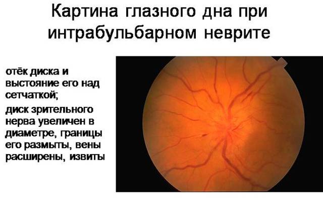 Отек зрительного нерва - симптомы, причины и лечение, профилактика