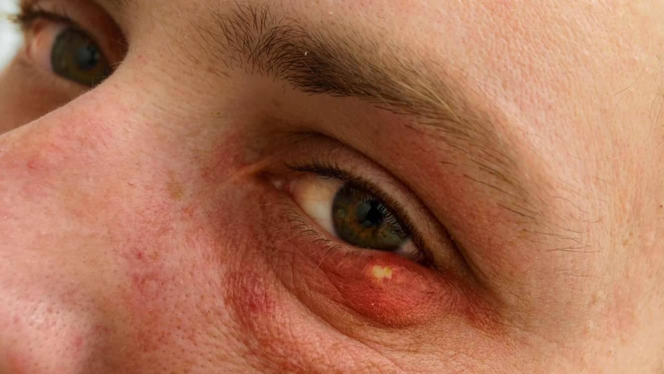 Чирей на глазу: лечение и как избавиться от фурункула