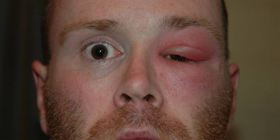 Флегмона глаза: что это за болезнь и как ее лечить, причины и симптомы