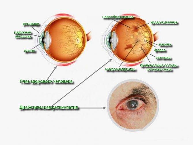 Ретинопатия – что это, как диагностируется и лечится недуг? — глаза эксперт