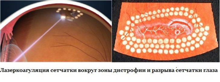 Лазерная коагуляция сетчатки глаза, послеоперационный период: рекомендации офтальмолога