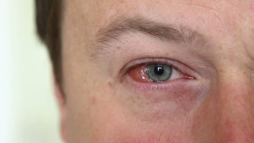 Герпес на веке глаза: симптомы и лечение заболевания