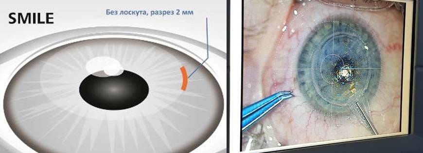 Сравнение методов коррекции зрения: ласик или фемтоласик, что лучше?