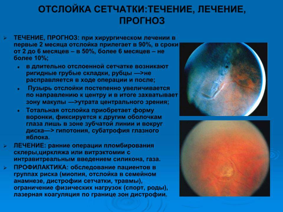 Отслойка сетчатки, лечение причины и симптомы. все о глазных болезнях - vseozrenii.