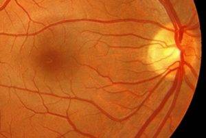 Что это такое макулопатия глаза: причины, виды, симптомы и лечение oculistic.ru
что это такое макулопатия глаза: причины, виды, симптомы и лечение