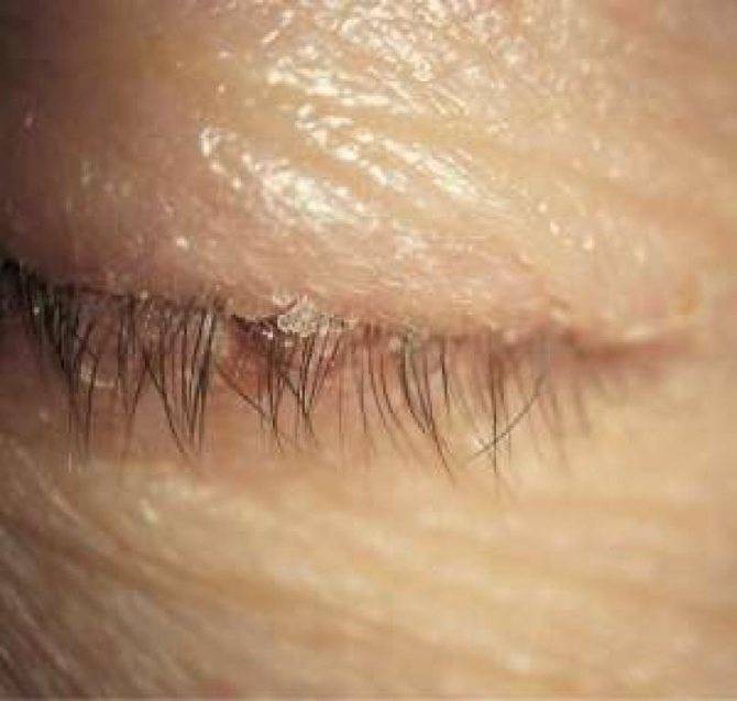 Клещи на ресницах глаз у человека: симптомы и лечение