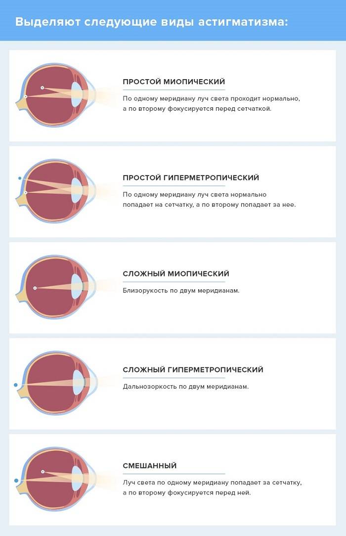Астигматизм глаз у взрослых: что это такое, симптомы и лечение