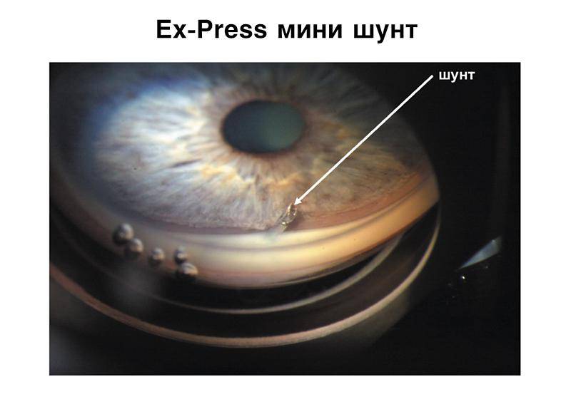 Лазерная трабекулопластика: операция при глаукоме