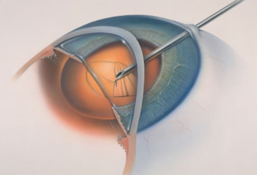 Послеоперационный период после замены хрусталика при катаракте