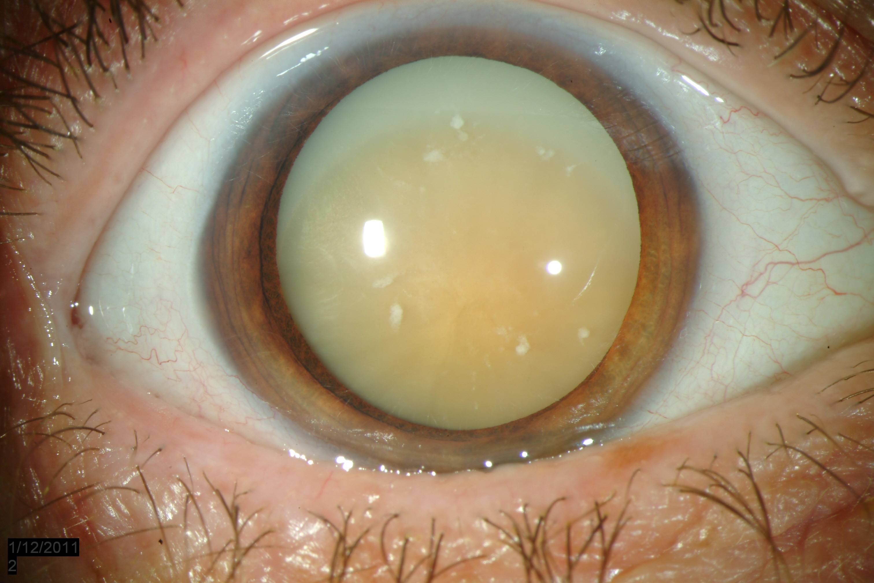 Факосклероз хрусталика глаза - что это, причины и лечение