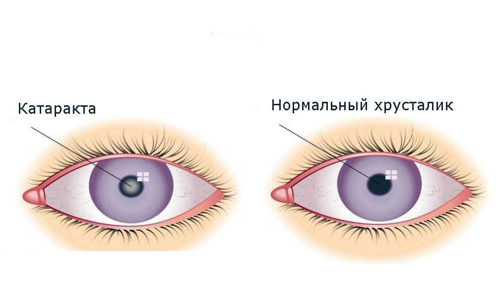 Лечение катаракты без операции, глазные капли, народные рецепты