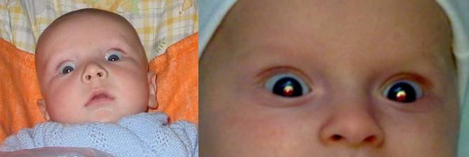 Почему появляется кровоизлияние в глазу у новорожденного?