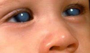 Причины врожденной катаракты у детей