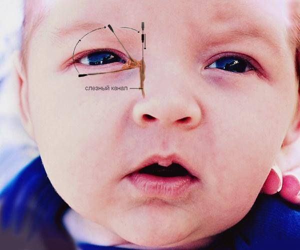 Дакриоцистит у новорожденных (детей): лечение, симптомы (фото), причины непроходимости слезного канала, массаж