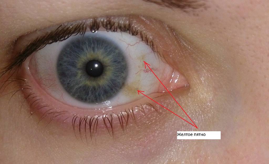 Желтое пятно на белке глаза - причины появления