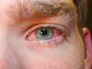 Красные сосуды в глазах у детей: причины покраснения сосудиков на белках у ребенка, лечение грудничка