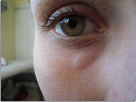 Болит глаз после сна: причины и лечение болей по утрам или после сна