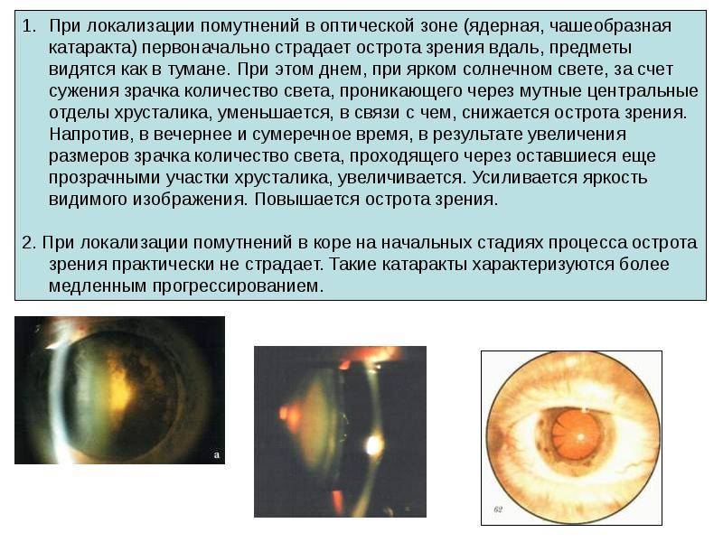 Что такое ядерная катаракта и как это лечится