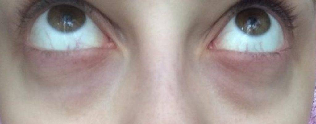 Круги под глазами – причины болезни у женщин, лечение