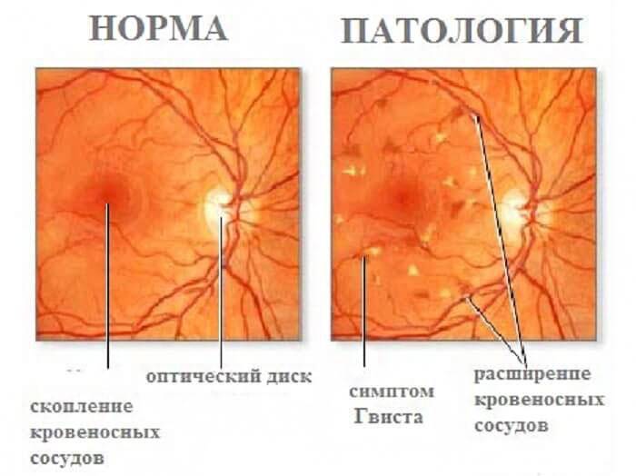 Ангиопатия сосудов сетчатки глаза: что это такое, у ребенка, у взрослого, симптомы, лечение