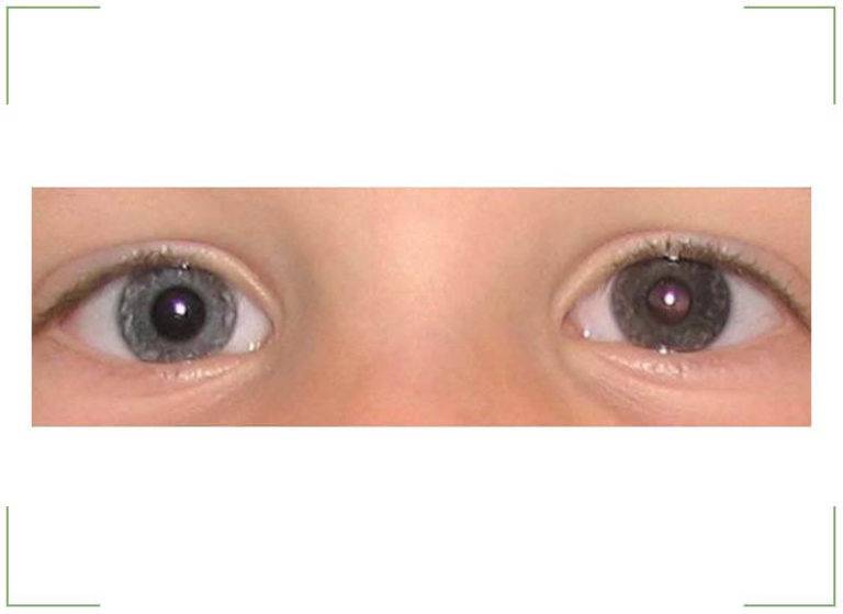 Зрачки разного размера у взрослого - причины анизокории глаз, почему, из-за чего